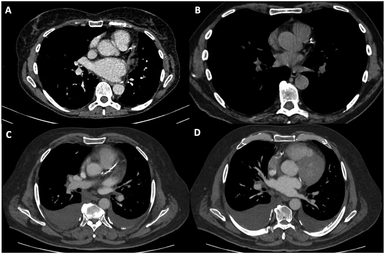 Source-provided article image: Coronary artery calcium score-emerging role for opportunistic screening on thoracic CT and novel applications.