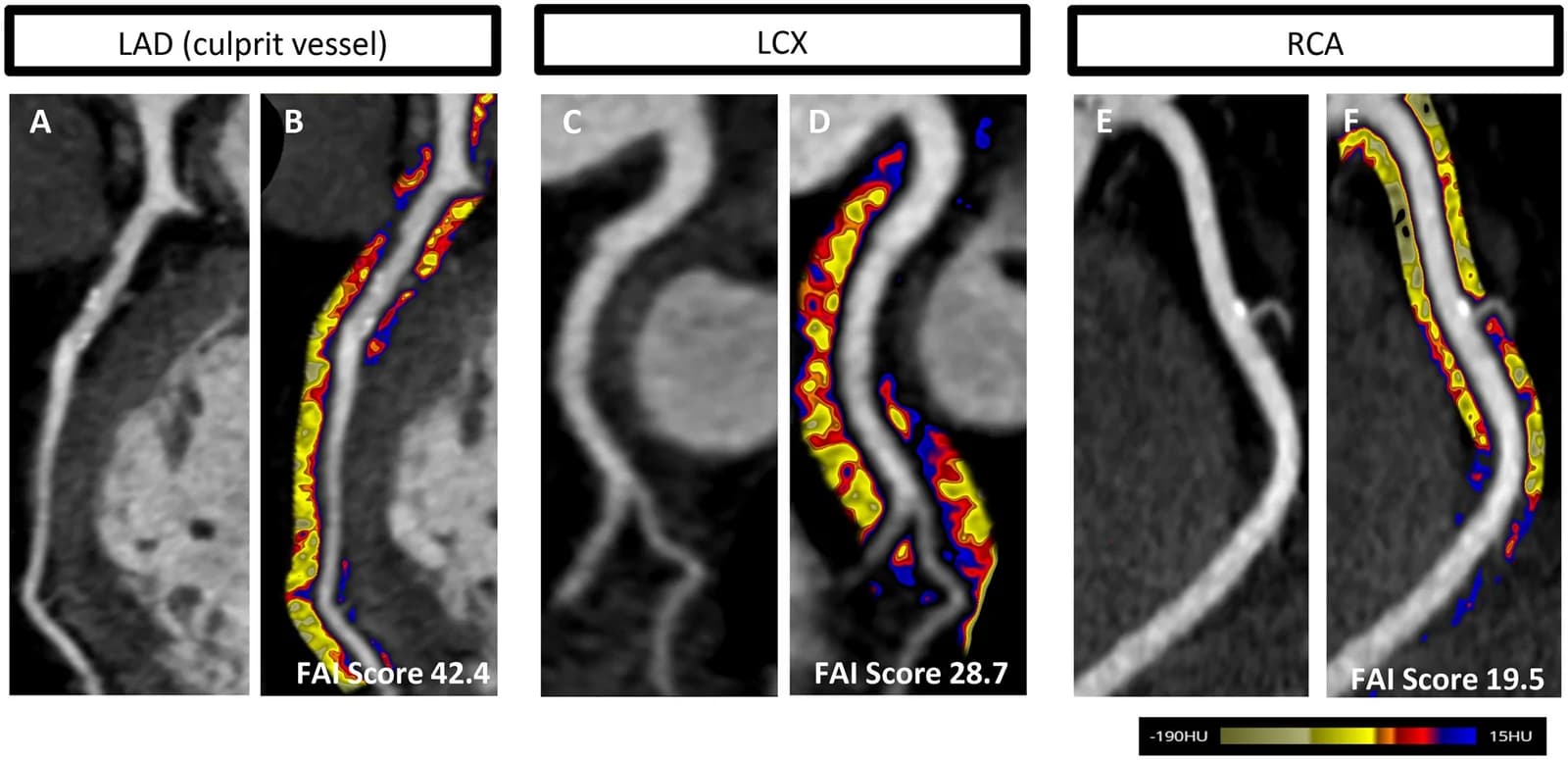 Source-provided article image: Pericoronary adipose tissue imaging: quantitative assessment, artificial intelligence integration, and therapeutic modulation.