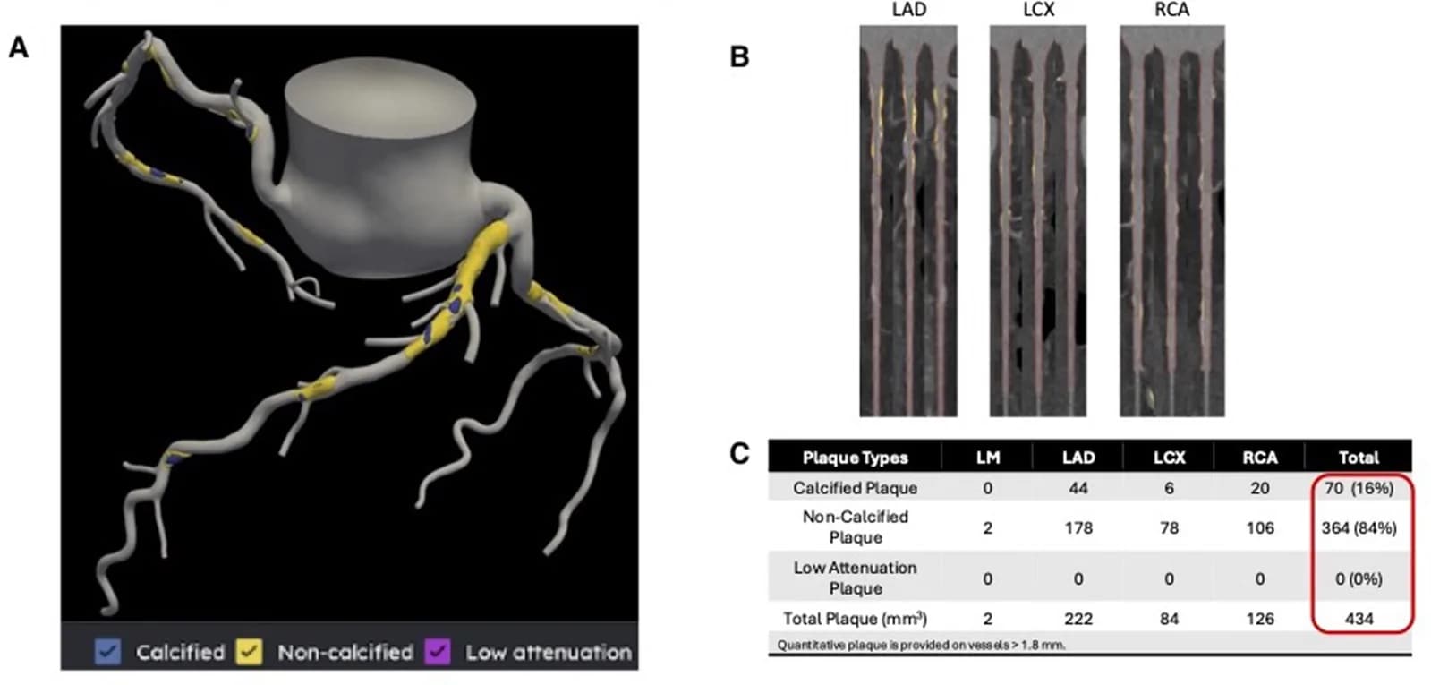 Source-provided article image: Advanced quantitative CT for coronary artery disease: integrating stenosis quantification, plaque quantification, and fractional flow reserve-CT.