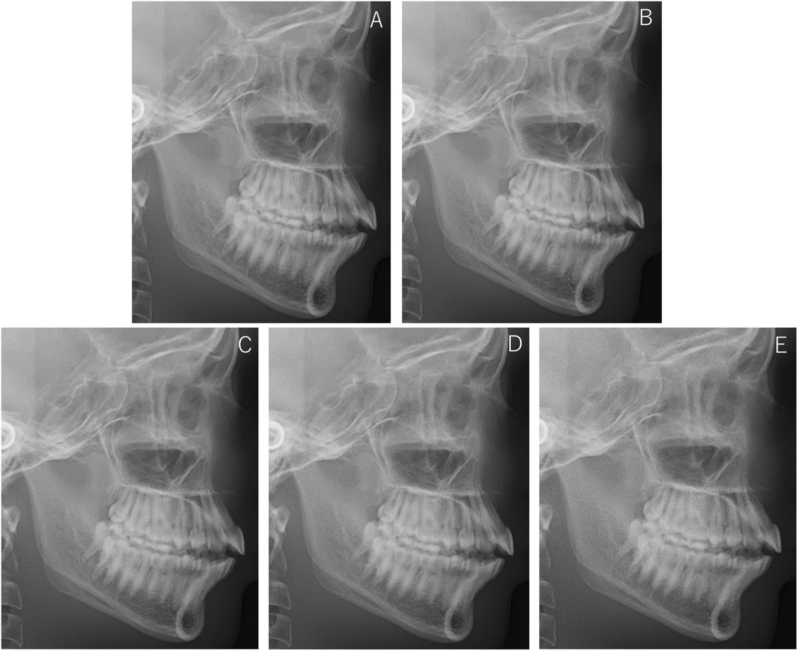 Source-provided article image: Image sharpening improves the visibility of reference points on low-dose lateral cephalometric radiographs: a phantom study.