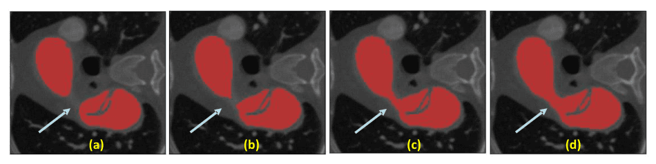 Source-provided article image: BiM-GeoAttn-Net: Linear-Time Depth Modeling with Geometry-Aware Attention for 3D Aortic Dissection CTA Segmentation