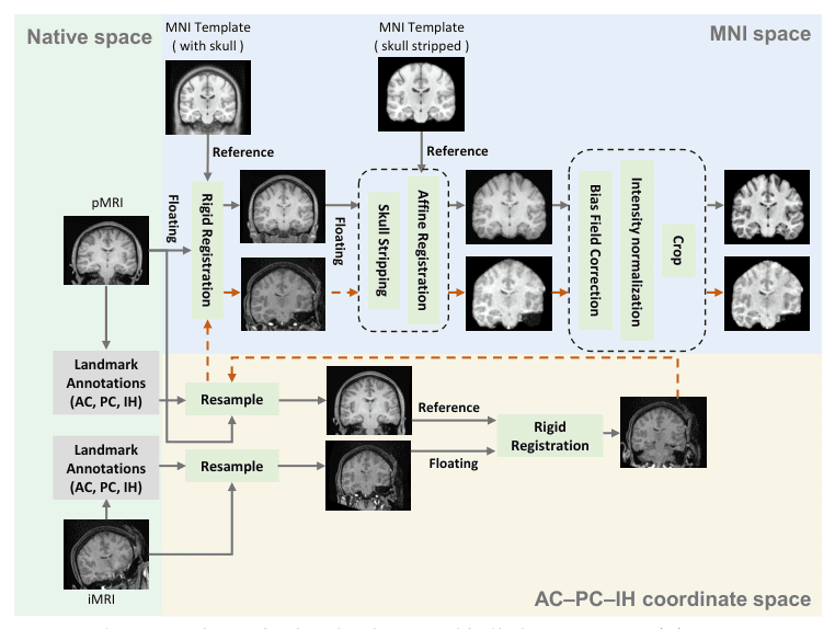 Source-provided article image: From pre- to intra-operative MRI: predicting brain shift in temporal lobe resection for epilepsy surgery